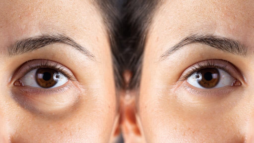 Blepharoplasty with Dr. Frankel's approach removes fat eyelids and gives you natural-looking results.