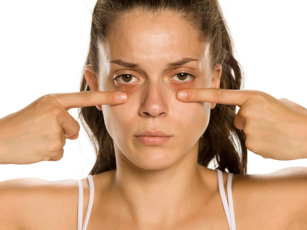 Contact an experienced surgeon to avoid dark circles caused by excessive removal of fat.