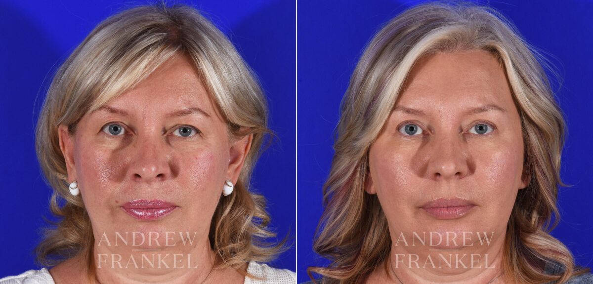 Blepharoplasty before and after photos in Beverly Hills, CA, Patient 11342