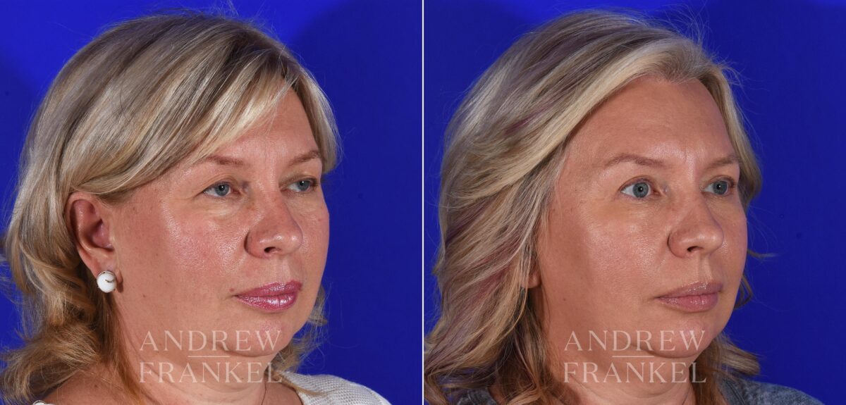 Blepharoplasty before and after photos in Beverly Hills, CA, Patient 11342