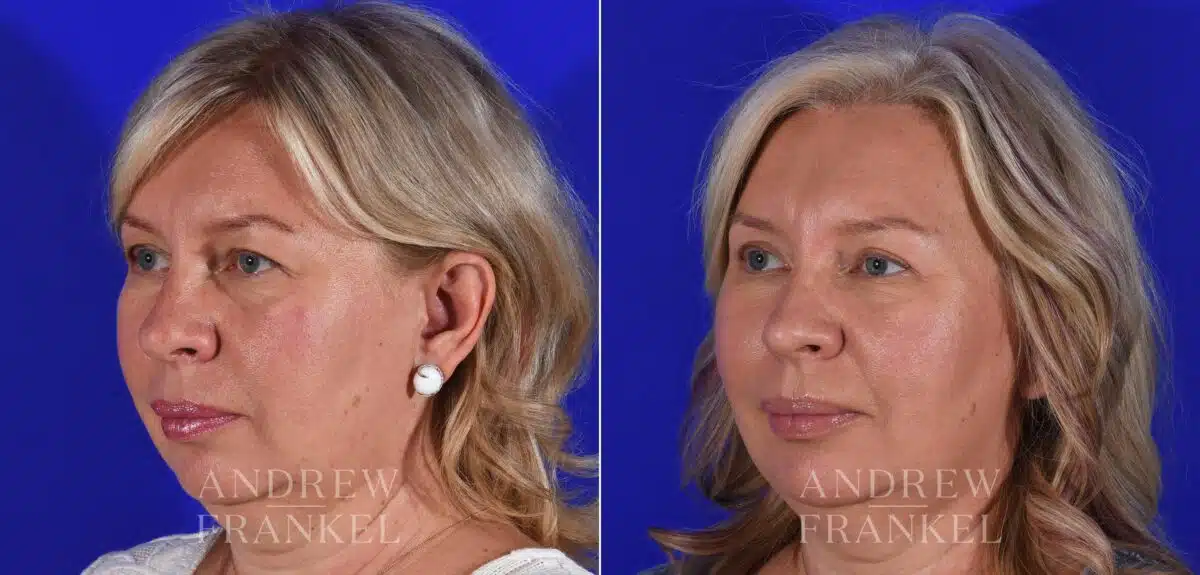 Blepharoplasty before and after photos in Beverly Hills, CA, Patient 11342