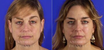 Blepharoplasty before and after photos in Beverly Hills, CA, Patient 3286