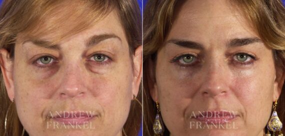 Blepharoplasty before and after photos in Beverly Hills, CA, Patient 3286