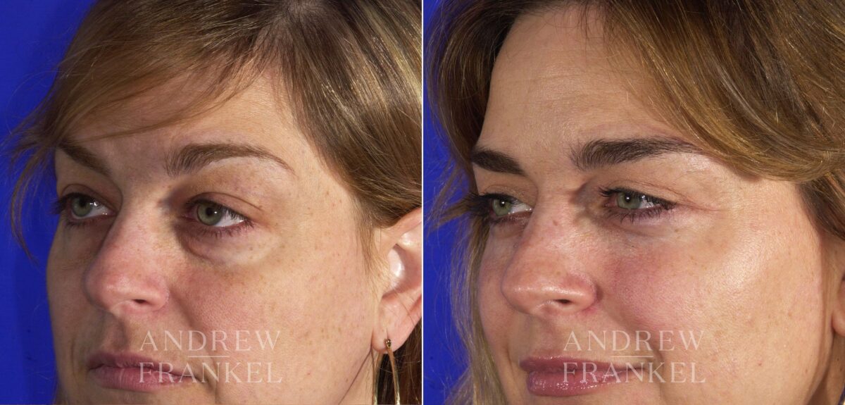 Blepharoplasty before and after photos in Beverly Hills, CA, Patient 3286