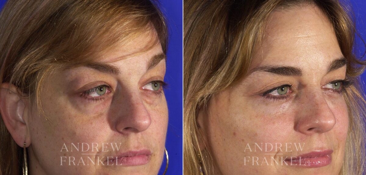 Blepharoplasty before and after photos in Beverly Hills, CA, Patient 3286