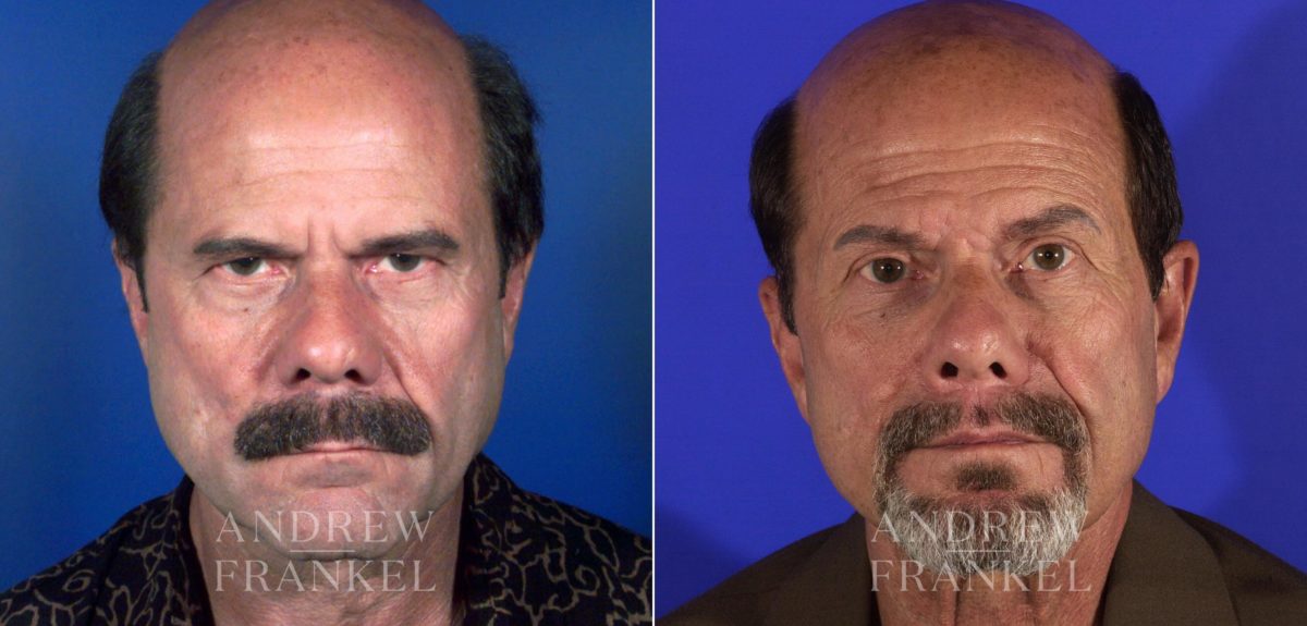 Blepharoplasty before and after photos in Beverly Hills, CA, Patient 14214
