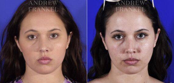 Jawline Contouring before and after photos in Beverly Hills, CA, Patient 11524