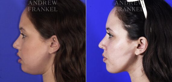 Jawline Contouring before and after photos in Beverly Hills, CA, Patient 11524