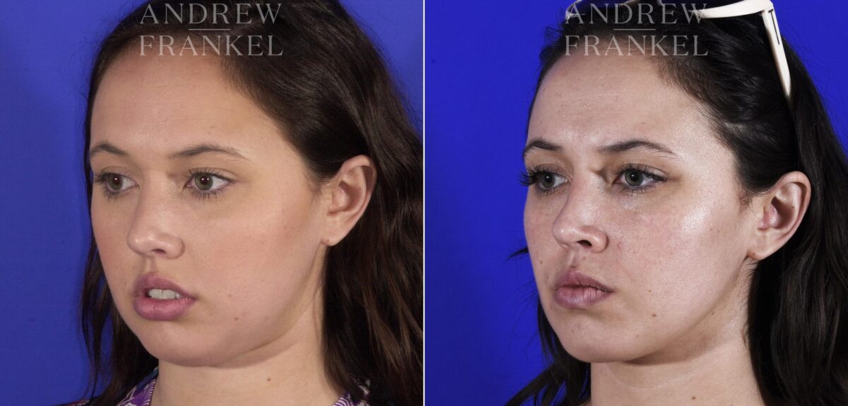 Jawline Contouring before and after photos in Beverly Hills, CA, Patient 11524