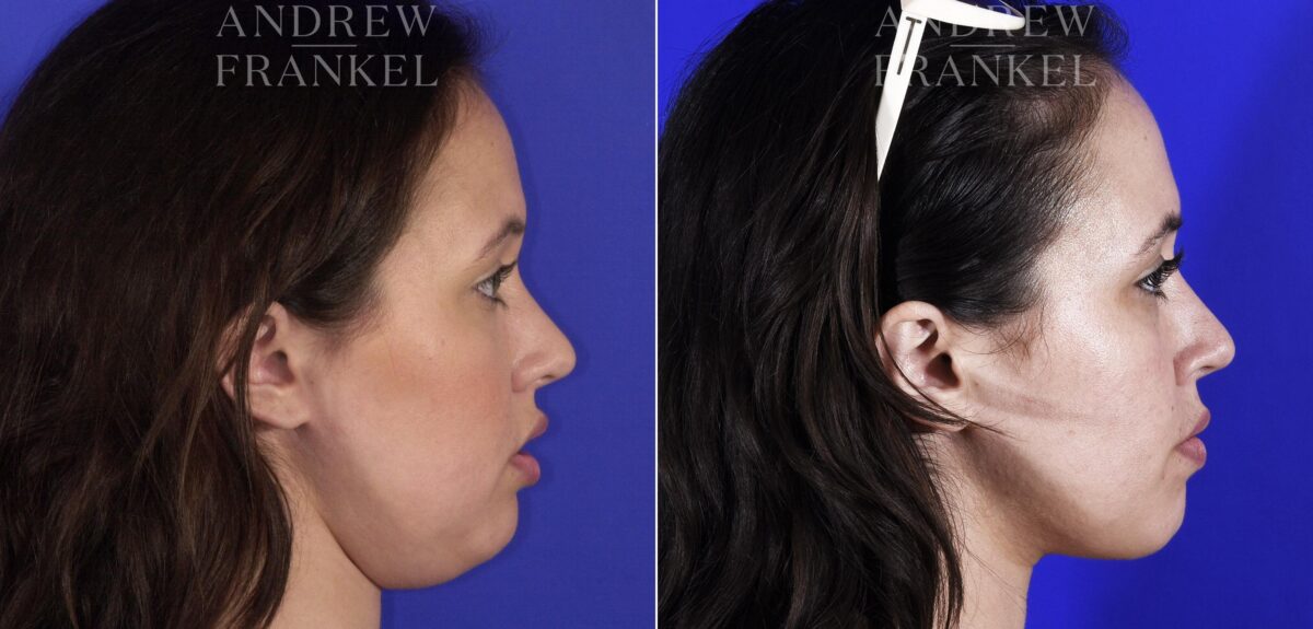 Jawline Contouring before and after photos in Beverly Hills, CA, Patient 11524