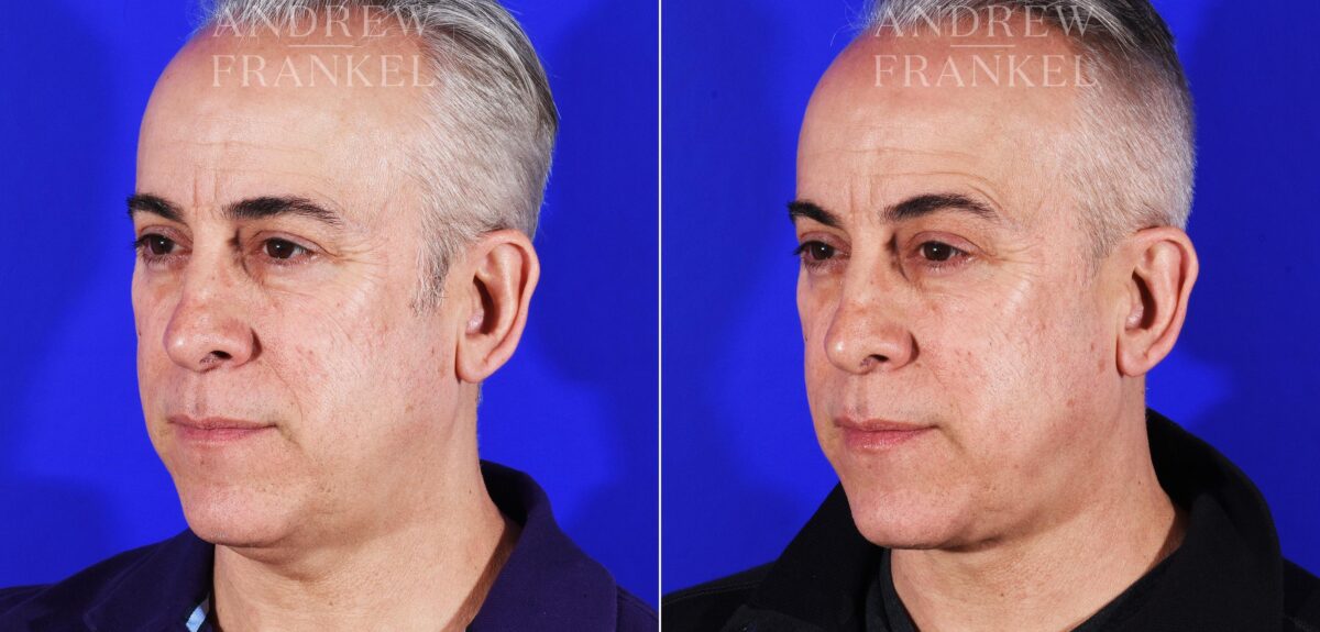 Neck Lift before and after photos in Beverly Hills, CA, Patient 11570