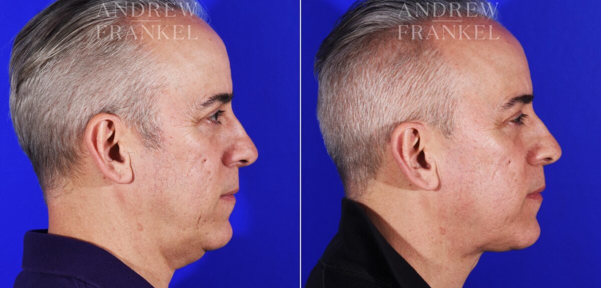 Neck Lift before and after photos in Beverly Hills, CA, Patient 11570