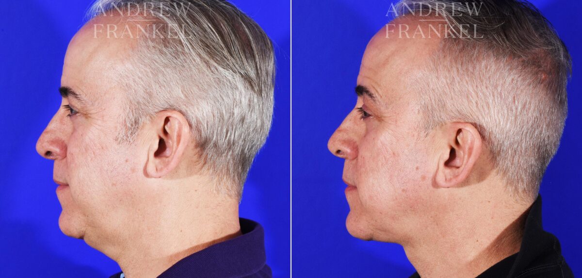 Neck Lift before and after photos in Beverly Hills, CA, Patient 11570