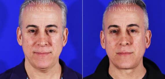 Neck Lift before and after photos in Beverly Hills, CA, Patient 11570