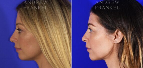 Jawline Contouring before and after photos in Beverly Hills, CA, Patient 11594