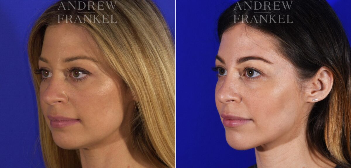 Jawline Contouring before and after photos in Beverly Hills, CA, Patient 11594