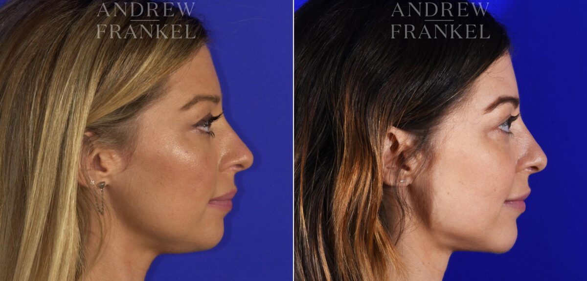Jawline Contouring before and after photos in Beverly Hills, CA, Patient 11594