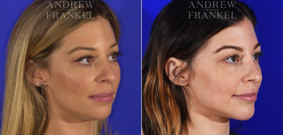Jawline Contouring before and after photos in Beverly Hills, CA, Patient 11594