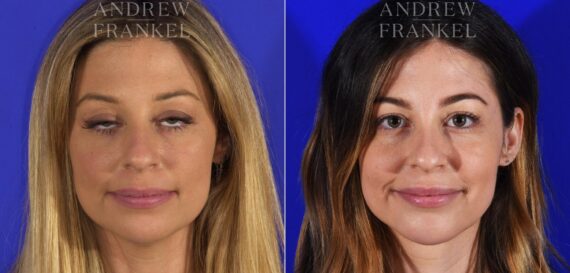 Jawline Contouring before and after photos in Beverly Hills, CA, Patient 11594