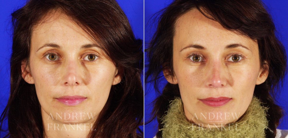Revision Rhinoplasty before and after photos in Beverly Hills, CA, Patient 3841