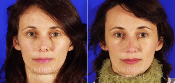 Revision Rhinoplasty before and after photos in Beverly Hills, CA, Patient 3841