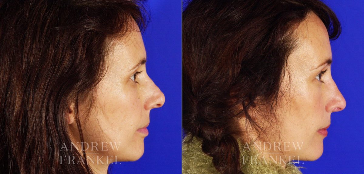 Revision Rhinoplasty before and after photos in Beverly Hills, CA, Patient 3841