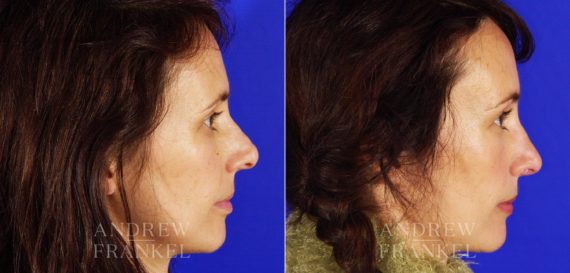 Revision Rhinoplasty before and after photos in Beverly Hills, CA, Patient 3841