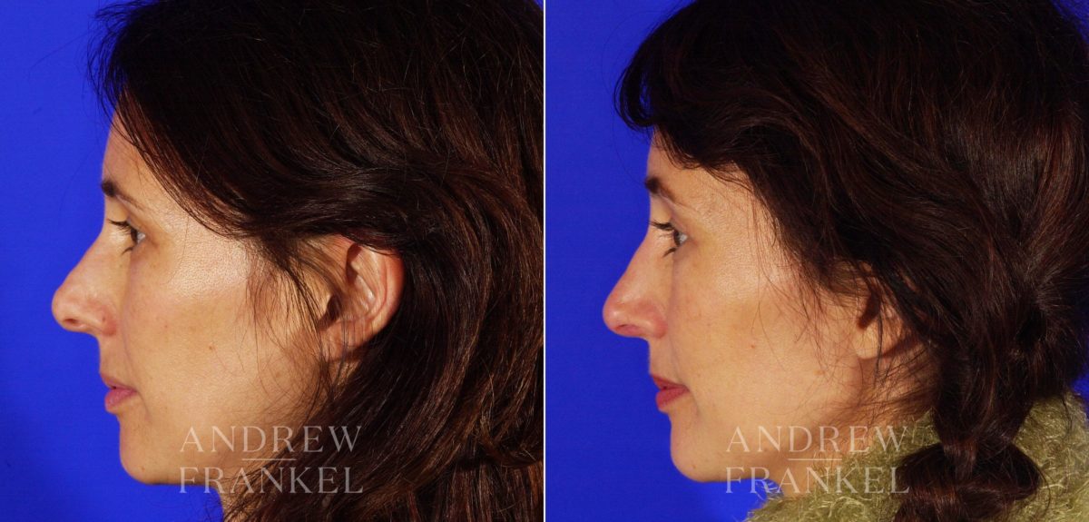 Revision Rhinoplasty before and after photos in Beverly Hills, CA, Patient 3841