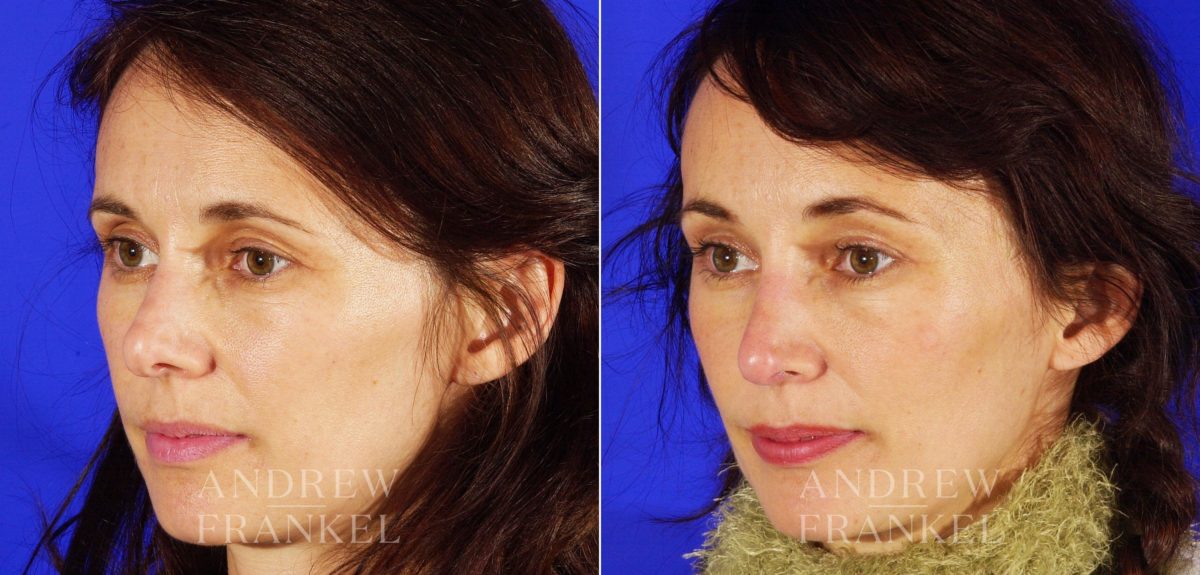 Revision Rhinoplasty before and after photos in Beverly Hills, CA, Patient 3841