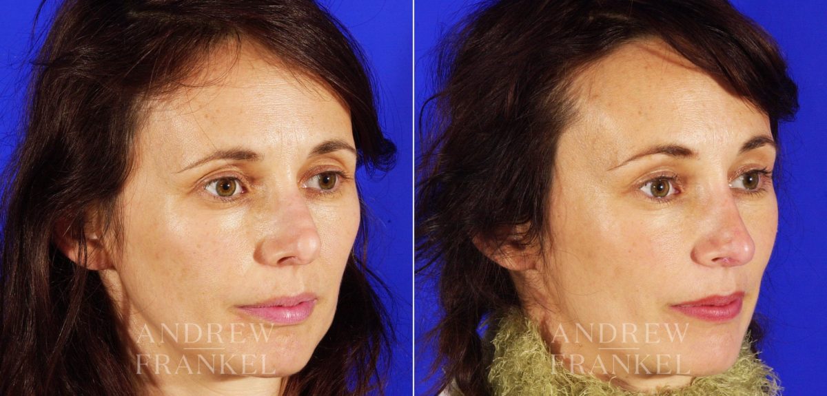 Revision Rhinoplasty before and after photos in Beverly Hills, CA, Patient 3841