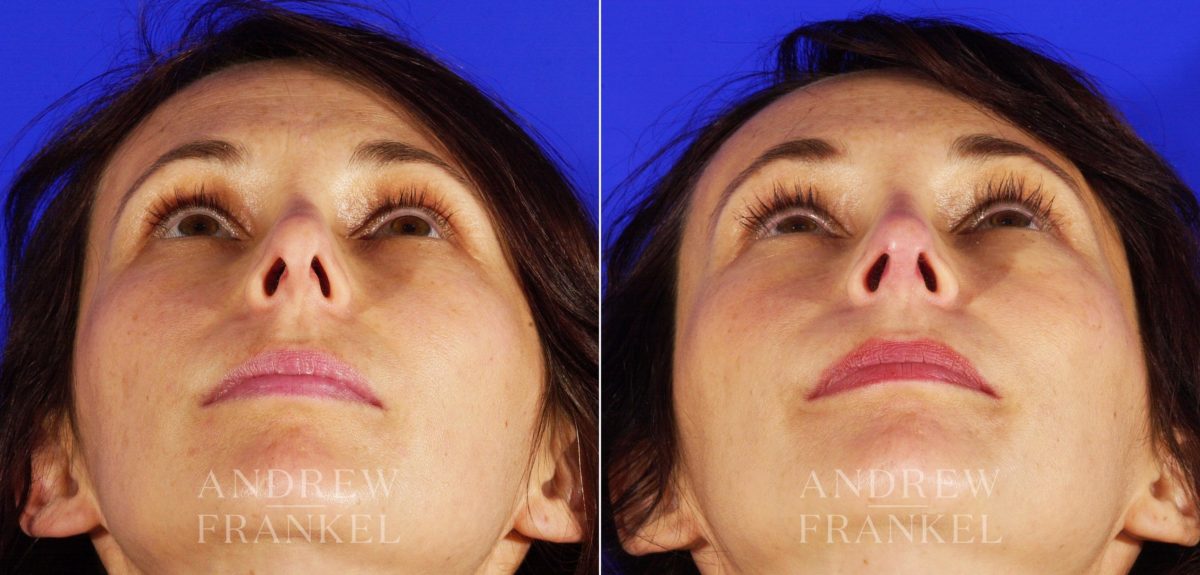 Revision Rhinoplasty before and after photos in Beverly Hills, CA, Patient 3841