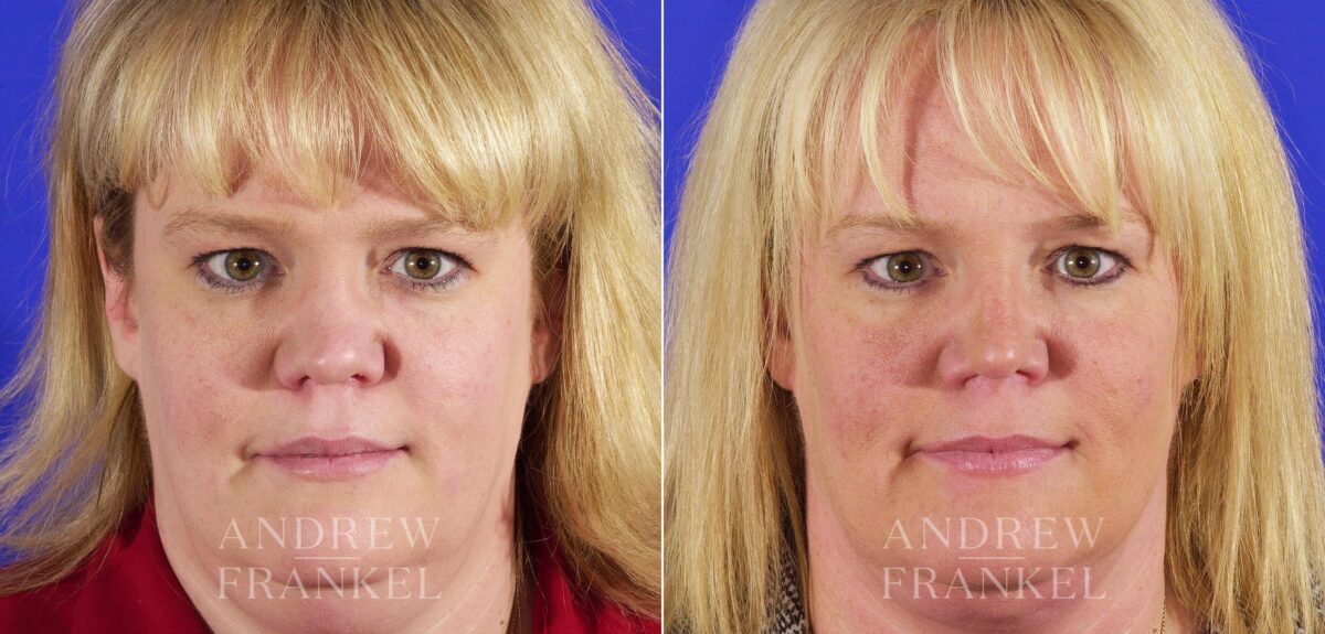 Revision Rhinoplasty before and after photos in Beverly Hills, CA, Patient 4346