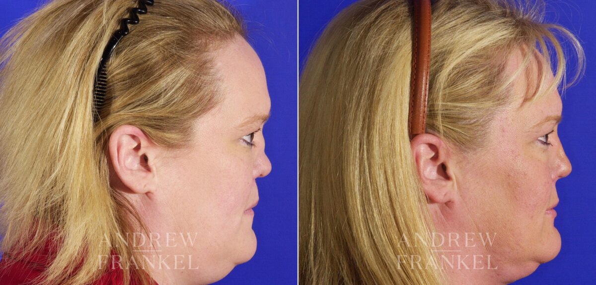 Revision Rhinoplasty before and after photos in Beverly Hills, CA, Patient 4346