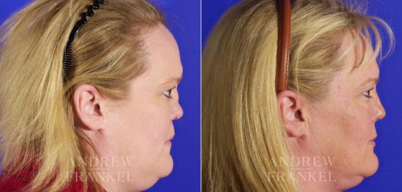 Revision Rhinoplasty before and after photos in Beverly Hills, CA, Patient 4346