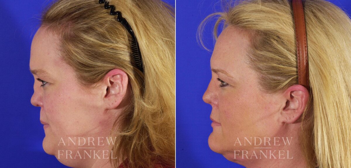 Revision Rhinoplasty before and after photos in Beverly Hills, CA, Patient 4346
