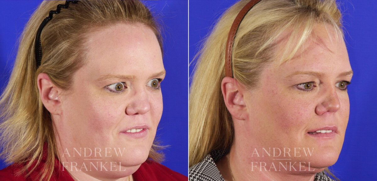 Revision Rhinoplasty before and after photos in Beverly Hills, CA, Patient 4346