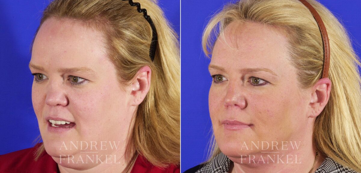 Revision Rhinoplasty before and after photos in Beverly Hills, CA, Patient 4346