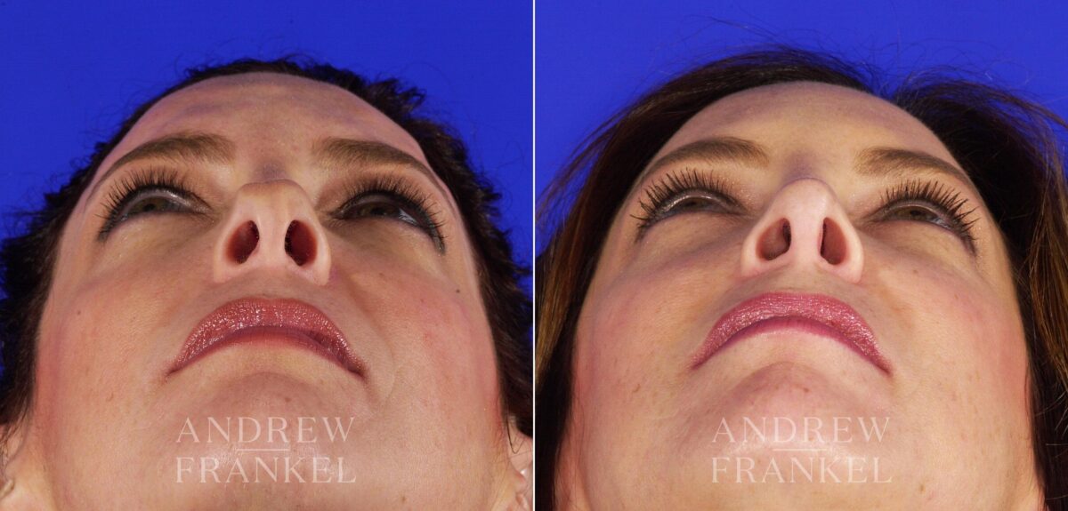 Revision Rhinoplasty before and after photos in Beverly Hills, CA, Patient 4358