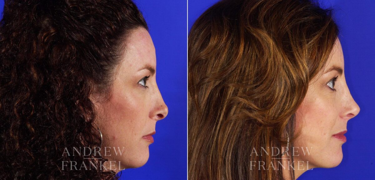 Revision Rhinoplasty before and after photos in Beverly Hills, CA, Patient 4358