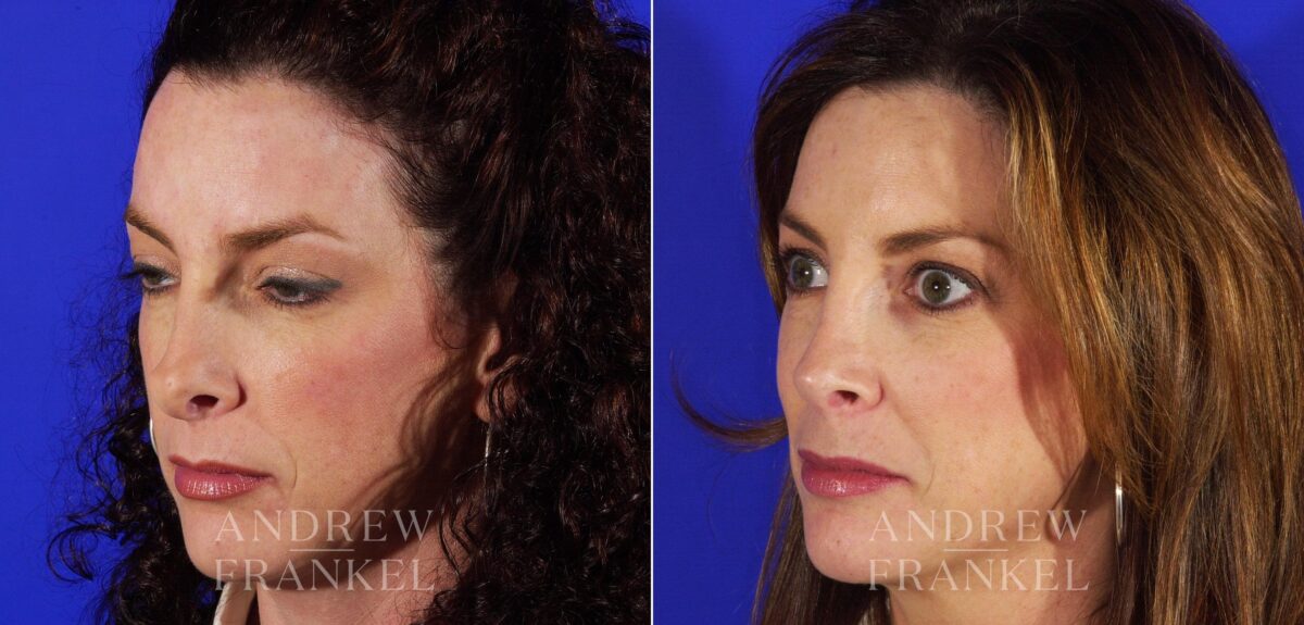 Revision Rhinoplasty before and after photos in Beverly Hills, CA, Patient 4358