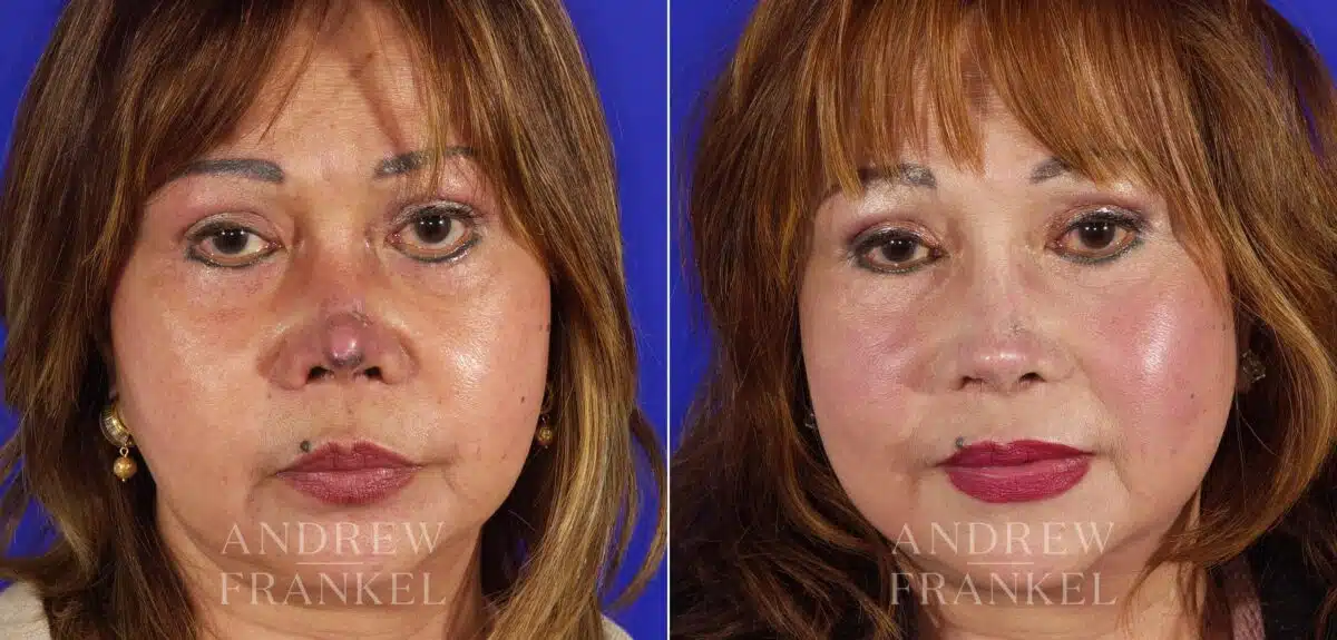 Revision Rhinoplasty before and after photos in Beverly Hills, CA, Patient 4527