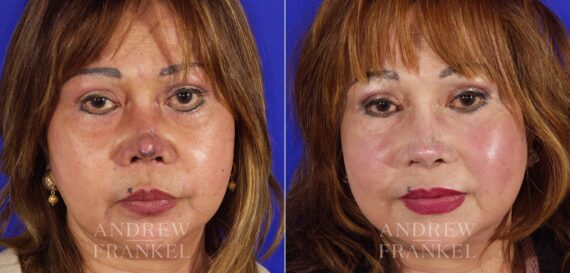 Revision Rhinoplasty before and after photos in Beverly Hills, CA, Patient 4527