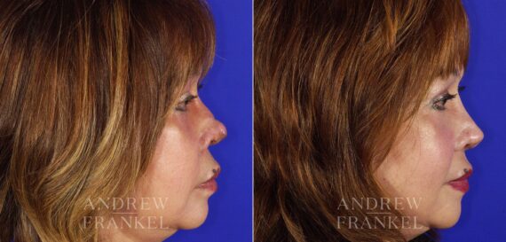 Revision Rhinoplasty before and after photos in Beverly Hills, CA, Patient 4527