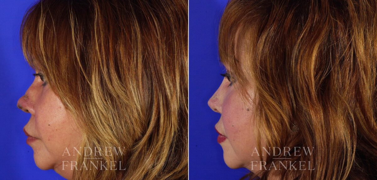 Revision Rhinoplasty before and after photos in Beverly Hills, CA, Patient 4527