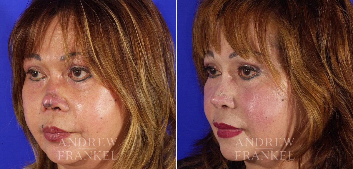 Revision Rhinoplasty before and after photos in Beverly Hills, CA, Patient 4527
