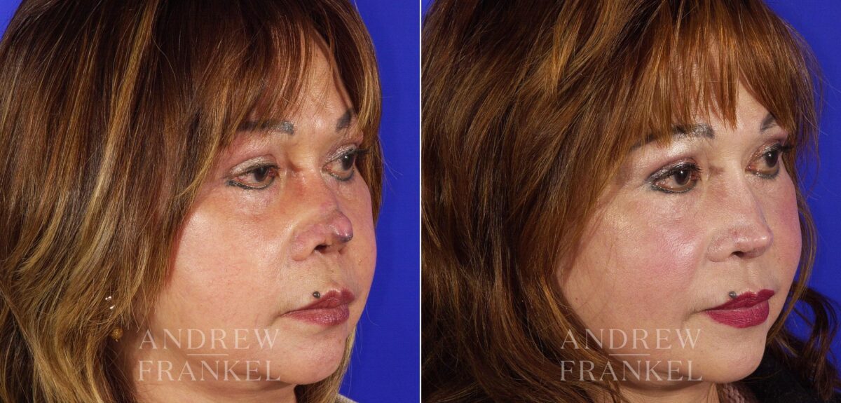 Revision Rhinoplasty before and after photos in Beverly Hills, CA, Patient 4527