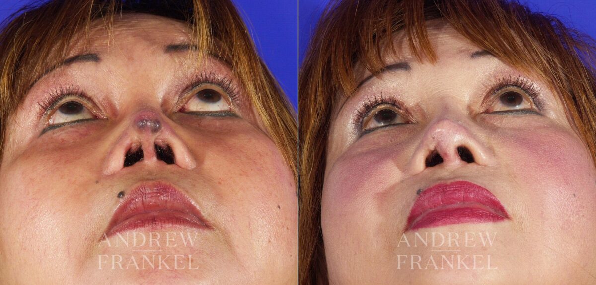 Revision Rhinoplasty before and after photos in Beverly Hills, CA, Patient 4527