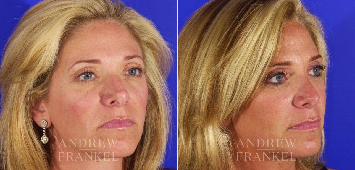 Revision Rhinoplasty before and after photos in Beverly Hills, CA, Patient 4611