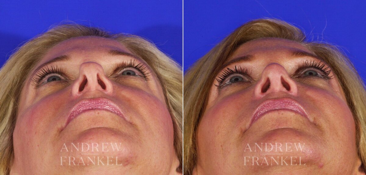 Revision Rhinoplasty before and after photos in Beverly Hills, CA, Patient 4611