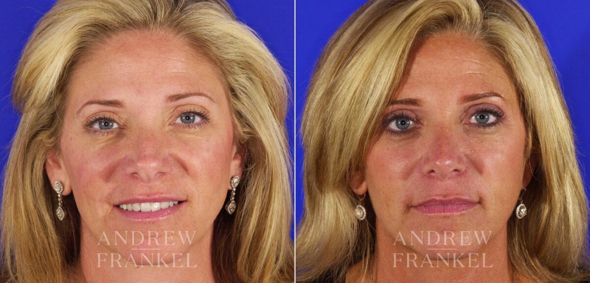 Revision Rhinoplasty before and after photos in Beverly Hills, CA, Patient 4611